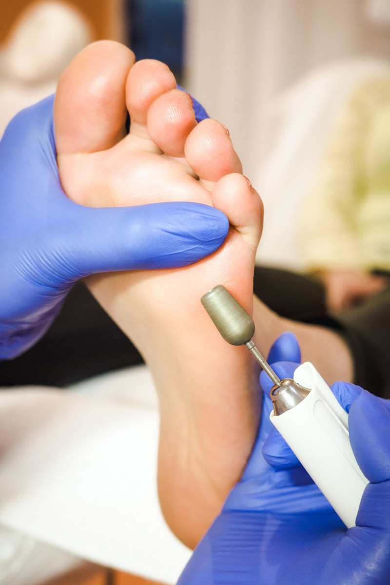 Tratamiento en el pie